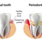 Tooth with gum disease or periodontitis