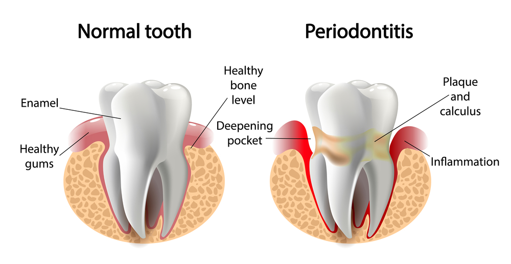 Tooth with gum disease or periodontitis